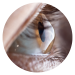 Oogaandoeningen keratoconus